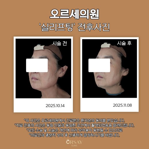 실리프팅 전후사진