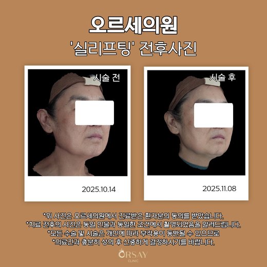 실리프팅 전후사진