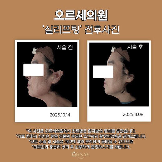 실리프팅 전후사진