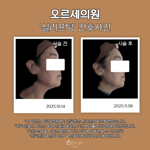 실리프팅 전후사진