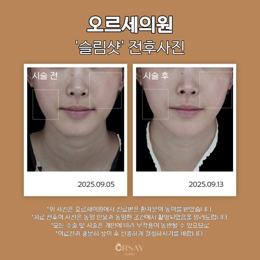 슬림샷 시술 전후 정면 사진, 2025.09.05 시술 전과 2025.09.13 시술 후