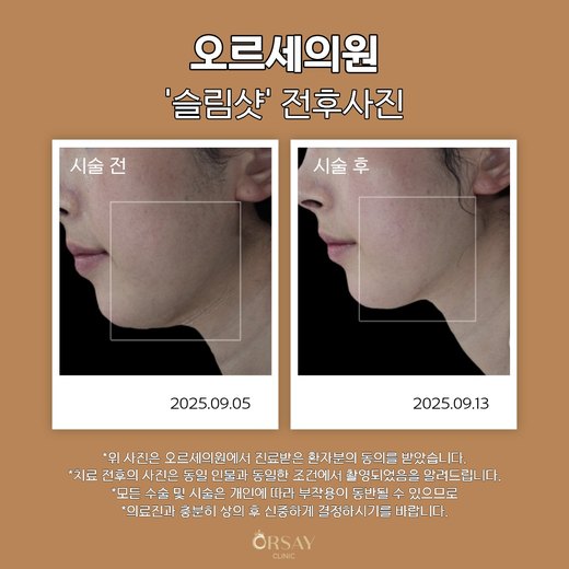 슬림샷 시술 전후 측면 턱선 사진, 2025.09.05 시술 전과 2025.09.13 시술 후