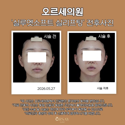 실루엣소프트 실리프팅 시술 전(2026.05.27)과 시술 직후 정면 사진
