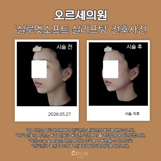 실루엣소프트 실리프팅 시술 전과 시술 직후 45도 측면 사진