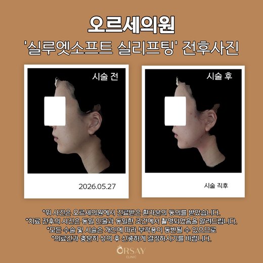 실루엣소프트 실리프팅 시술 전과 시술 직후 90도 측면 사진