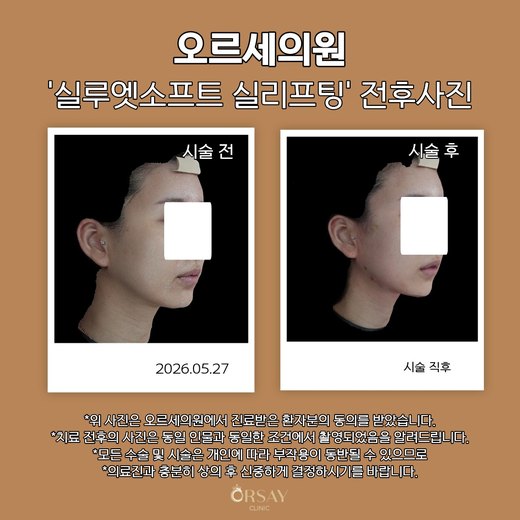 실루엣소프트 실리프팅 시술 전과 시술 직후 반대쪽 45도 측면 사진