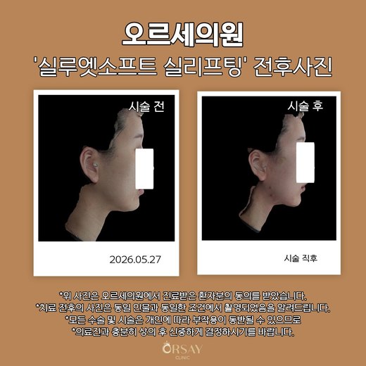 실루엣소프트 실리프팅 시술 전과 시술 직후 반대쪽 90도 측면 사진