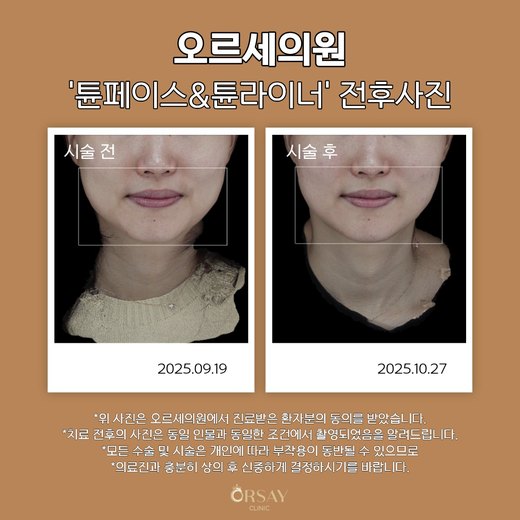 튠페이스·튠라이너 시술 전후 정면 사진 (2025.09.19, 2025.10.27)