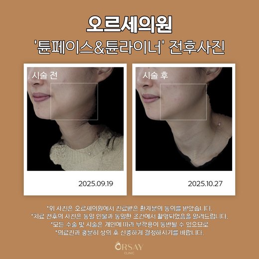 튠페이스·튠라이너 시술 전후 측면과 45도 사진 왼쪽 (2025.09.19, 2025.10.27)