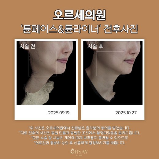 튠페이스·튠라이너 시술 전후 측면과 45도 사진 오른쪽 (2025.09.19, 2025.10.27)