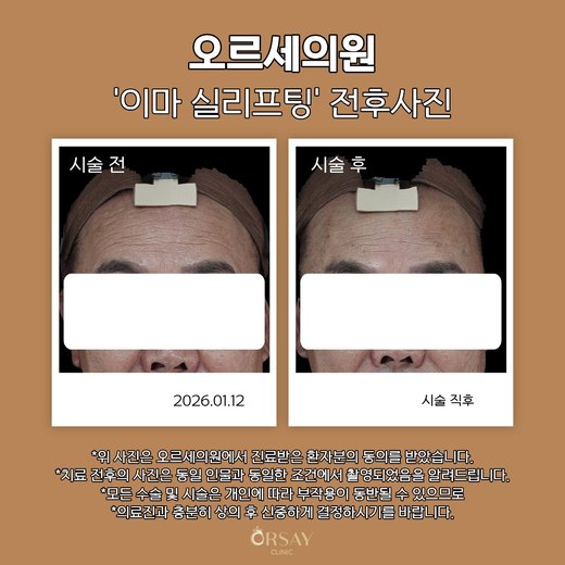 이마 실리프팅 볼륨실 시술 전후 정면 이마 근접 사진 2026.01.12