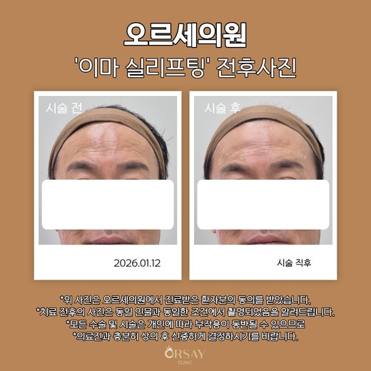 이마 실리프팅 볼륨실 시술 전후 정면 사진 2026.01.12