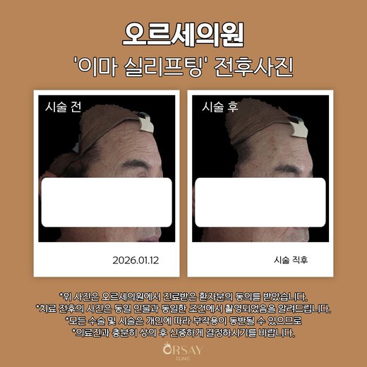 이마 실리프팅 볼륨실 시술 전후 45도 측면 사진 2026.01.12