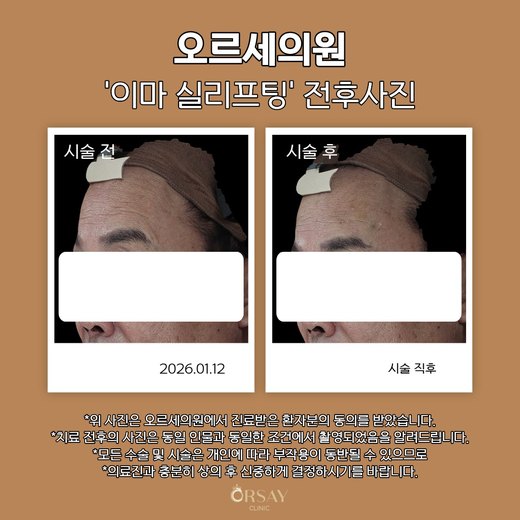 이마 실리프팅 볼륨실 시술 전후 45도 측면 사진 2026.01.12