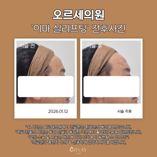 이마 실리프팅 볼륨실 시술 전후 측면 사진 2026.01.12