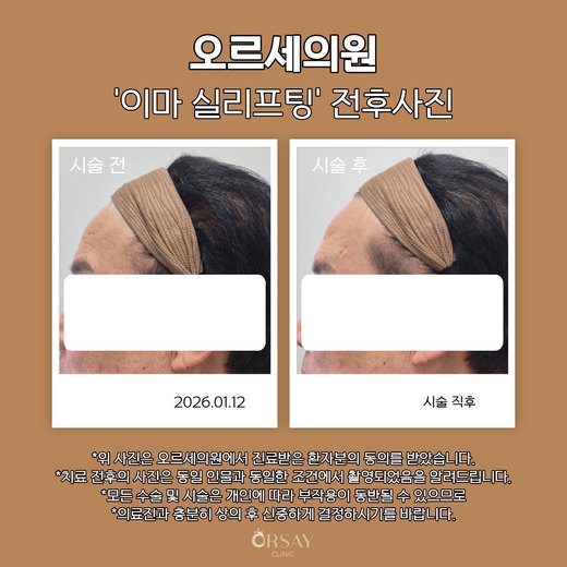 이마 실리프팅 볼륨실 시술 전후 측면 사진 2026.01.12