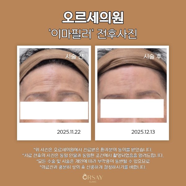 68세 여성 이마필러 시술 전과 시술 3주 후 정면 전후사진