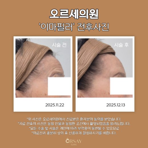 68세 여성 이마필러 시술 전과 시술 3주 후 측면 전후사진