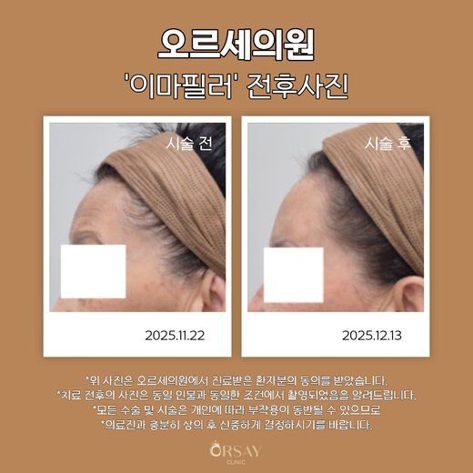 68세 여성 이마필러 시술 전과 시술 3주 후 측면 전후사진