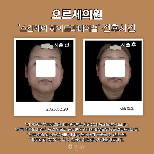 스킨케어 하이드라페이셜 전후사진 정면, 시술 전과 시술 직후