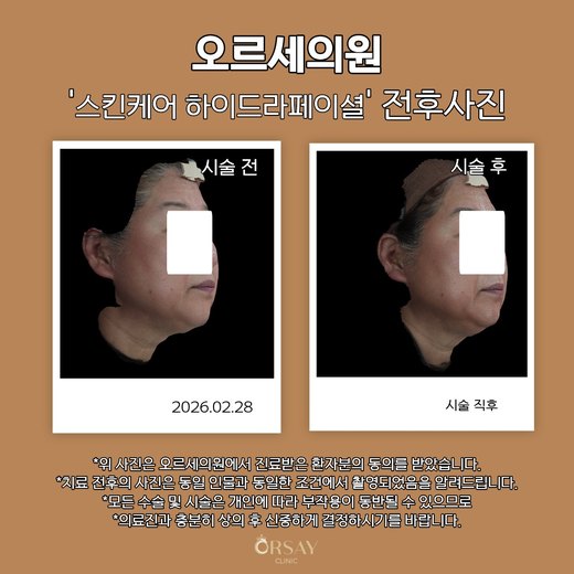 스킨케어 하이드라페이셜 전후사진 45도 측면, 시술 전과 시술 직후