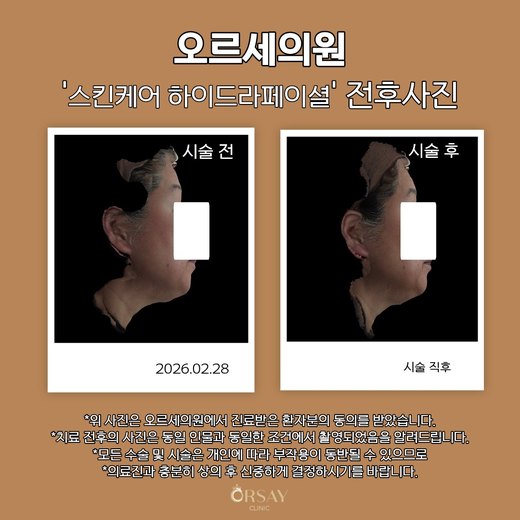스킨케어 하이드라페이셜 전후사진 90도 측면, 시술 전과 시술 직후