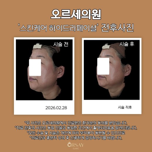 스킨케어 하이드라페이셜 전후사진 반대쪽 45도 측면, 시술 전과 시술 직후