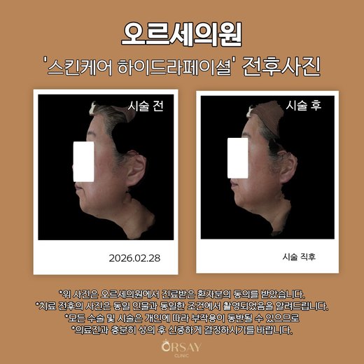 스킨케어 하이드라페이셜 전후사진 반대쪽 90도 측면, 시술 전과 시술 직후
