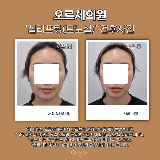 모노실 실리프팅 턱선 전후사진