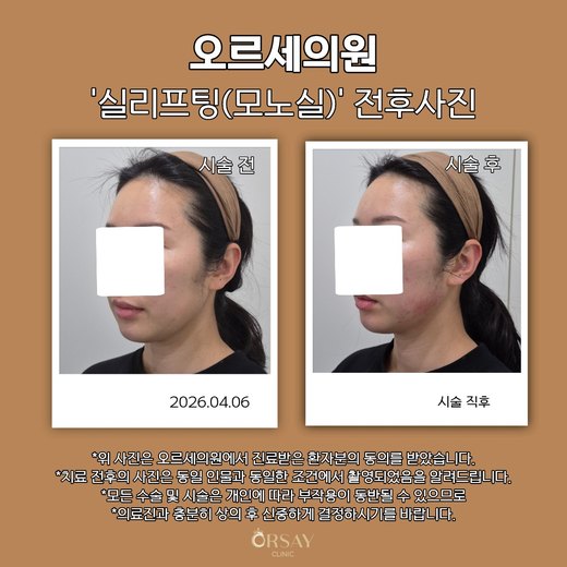 모노실 실리프팅 턱선 전후사진