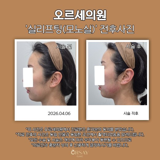 모노실 실리프팅 턱선 전후사진