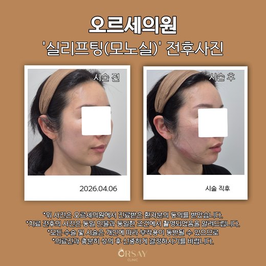 모노실 실리프팅 턱선 전후사진