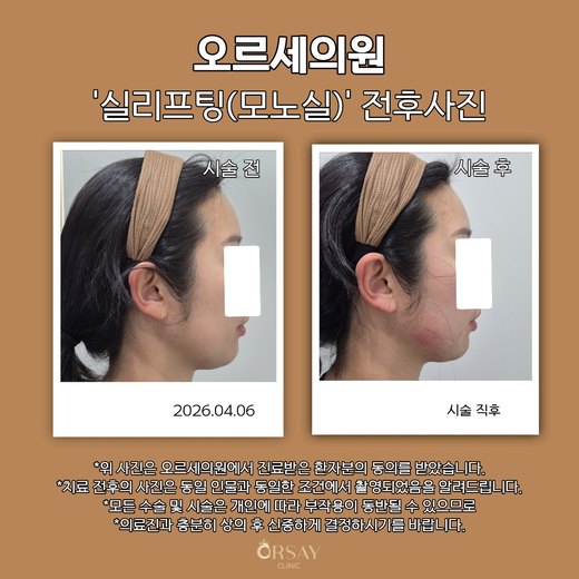 모노실 실리프팅 턱선 전후사진