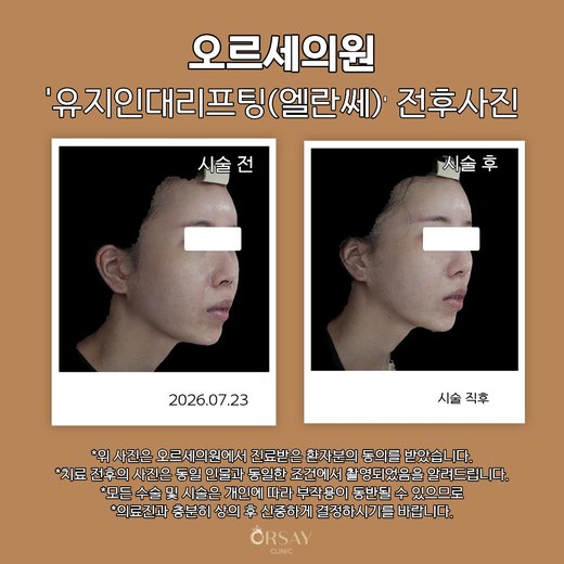 유지인대리프팅(엘란쎄) 전후사진 45도