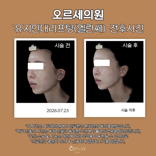 유지인대리프팅(엘란쎄) 전후사진 45도