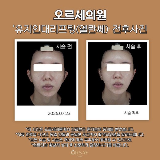 유지인대리프팅(엘란쎄) 전후사진 정면