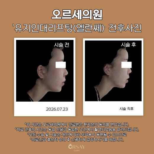 유지인대리프팅(엘란쎄) 전후사진 측면