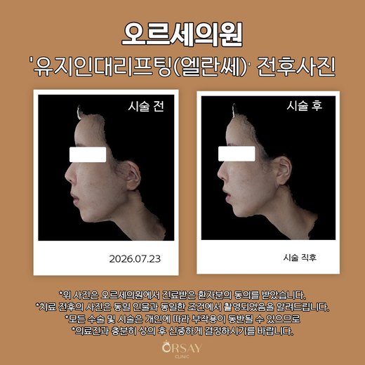 유지인대리프팅(엘란쎄) 전후사진 측면