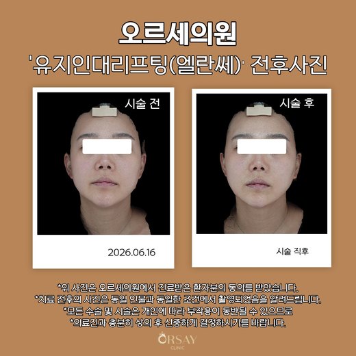 유지인대리프팅(엘란쎄) 전후사진 정면 2026.06.16