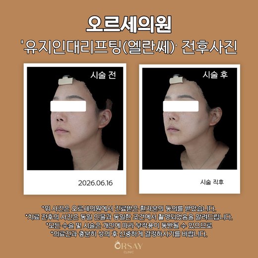 유지인대리프팅(엘란쎄) 전후사진 45도 2026.06.16