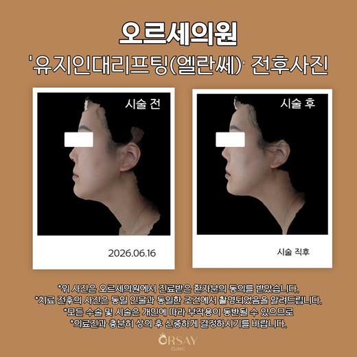 유지인대리프팅(엘란쎄) 전후사진 측면 2026.06.16