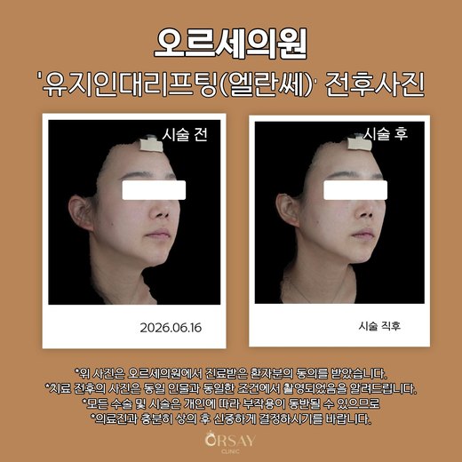 유지인대리프팅(엘란쎄) 전후사진 45도 2026.06.16