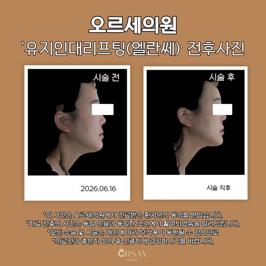 유지인대리프팅(엘란쎄) 전후사진 측면 2026.06.16