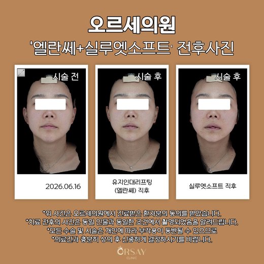 유지인대리프팅·실루엣소프트 전후사진 2026.06.16