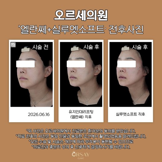 유지인대리프팅·실루엣소프트 전후사진 2026.06.16