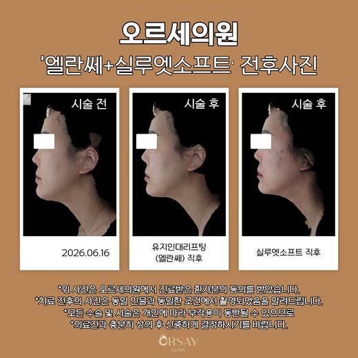 유지인대리프팅·실루엣소프트 전후사진 2026.06.16
