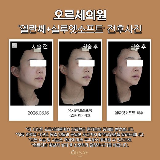 유지인대리프팅·실루엣소프트 전후사진 2026.06.16