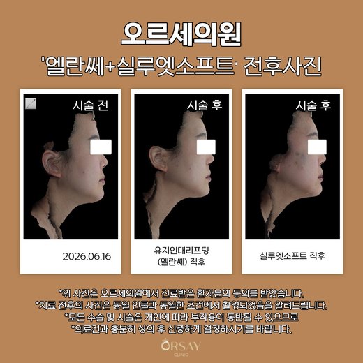 유지인대리프팅·실루엣소프트 전후사진 2026.06.16
