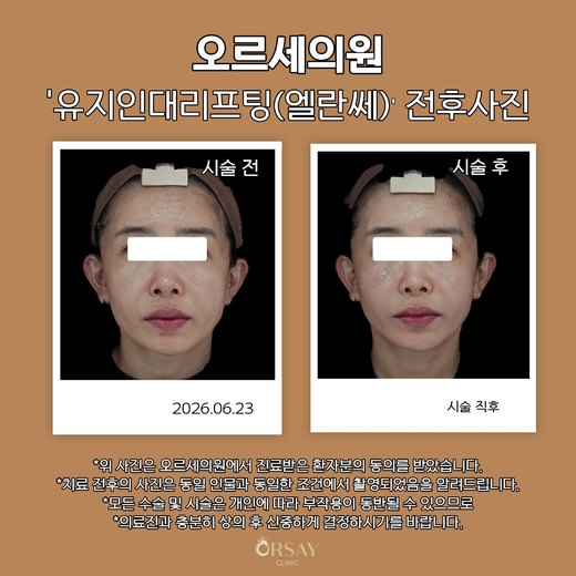 유지인대리프팅(엘란쎄) 전후사진 2026.06.23