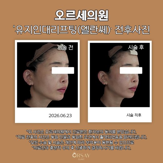 유지인대리프팅(엘란쎄) 전후사진 2026.06.23